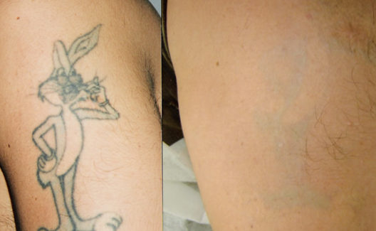 A tinta branca cobre o preto na reforma de uma tatuagem?